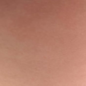 BİM Selülit Kremi Cildimi Yaktı Ve Alerjik Reaksiyona Sebep Oldu