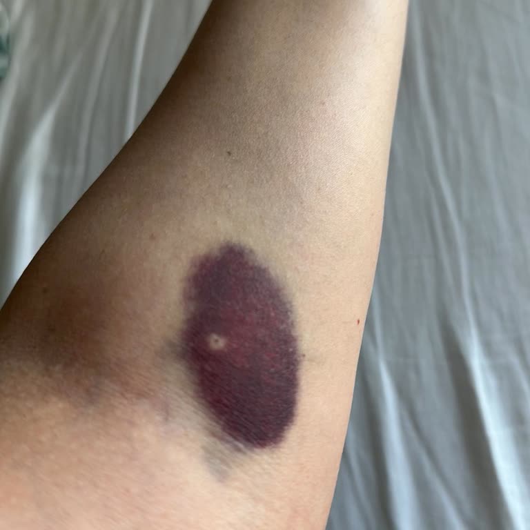 Avrasya Hastanesi'nde Tekrar Eden Hemşire Hatası Ve İlgisiz Yaklaşım