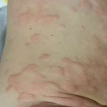 Cappy Pulpy Sonrası Şiddetli Alerjik Reaksiyon