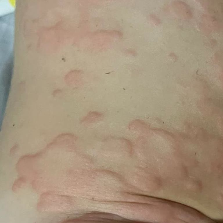 Cappy Pulpy Sonrası Şiddetli Alerjik Reaksiyon