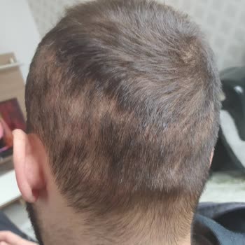 Saç Ekimi Sonrası Memnuniyetsizlik Ve Kalıcı Sorunlar