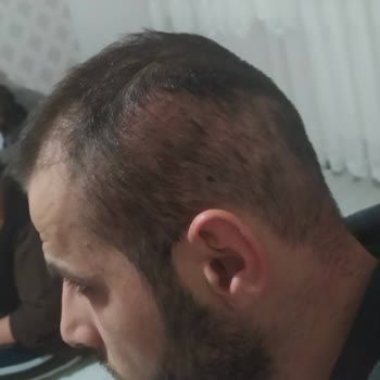 Saç Ekimi Sonrası Memnuniyetsizlik Ve Kalıcı Sorunlar