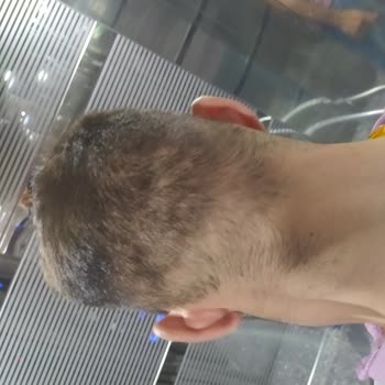 Saç Ekimi Sonrası Memnuniyetsizlik Ve Kalıcı Sorunlar