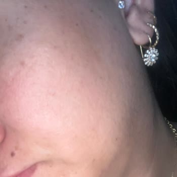 Leke Tedavisi Sonrası Artan Sorunlar Ve Hayal Kırıklığı