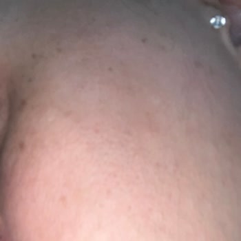 Leke Tedavisi Sonrası Artan Sorunlar Ve Hayal Kırıklığı