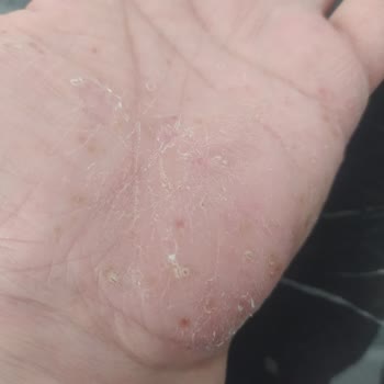 Fairy Bulaşık Deterjanı Cildimde Alerjiye Sebep Oldu!