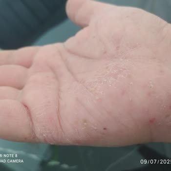 Fairy Bulaşık Deterjanı Cildimde Alerjiye Sebep Oldu!