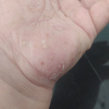 Fairy Bulaşık Deterjanı Cildimde Alerjiye Sebep Oldu!