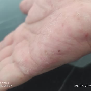 Fairy Bulaşık Deterjanı Cildimde Alerjiye Sebep Oldu!