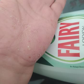 Fairy Bulaşık Deterjanı Cildimde Alerjiye Sebep Oldu!