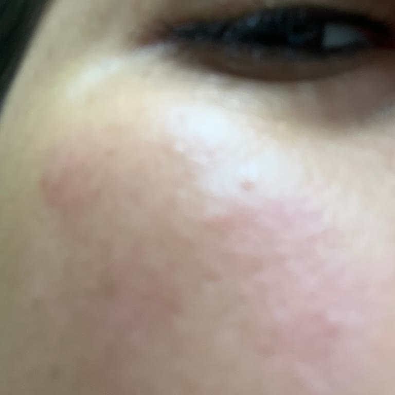 Crema y Tónico Caudalie causan enrojecimiento y acné en mi piel