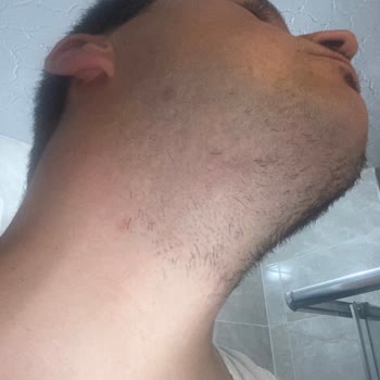 İade Edilmeyen Tıraş Makinesi Cildime Zarar Verdi, LCW Ve Philips'ten Mağduriyet