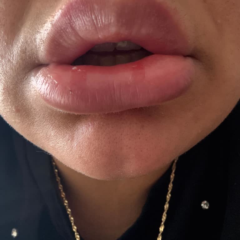 Dudak Dolgusu Ve Botoks İşleminden Memnun Kalmadım