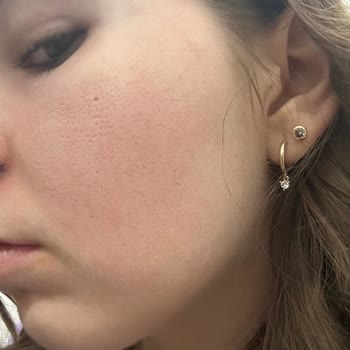 Bioderma Güneş Kremi Yüzümü Yaktı Ve Kızarıklık Yaptı