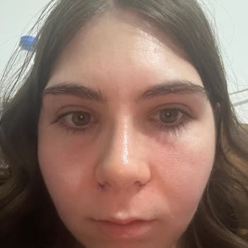 Bioderma Güneş Kremi Yüzümü Yaktı Ve Kızarıklık Yaptı