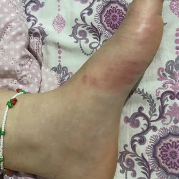 Sandalet Kullanımı Sonrası Ayağımda Ciddi Sorunlar Oluştu