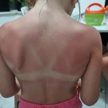 Mustela Güneş Kremi Çocuğumda Yanık Oluşturdu, İade Talebim Var