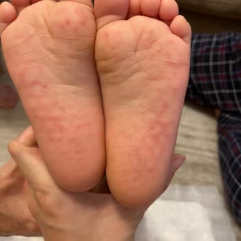 Vicco Bebek Sandaletinde Cilt Sorunu Ve Mağduriyetin Giderilmemesi