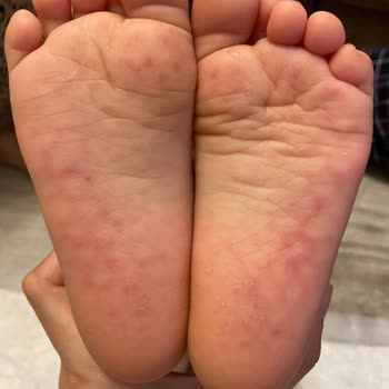 Vicco Bebek Sandaletinde Cilt Sorunu Ve Mağduriyetin Giderilmemesi