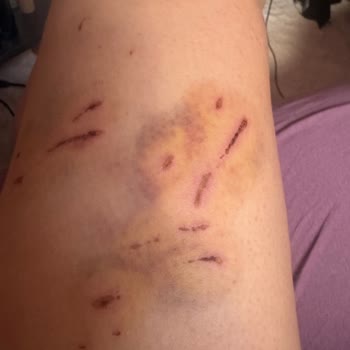 Zorunlu Kuduz Ve Tetanos Aşısı İçin Ücret Talep Edilmesi Mağduriyet Yaratıyor