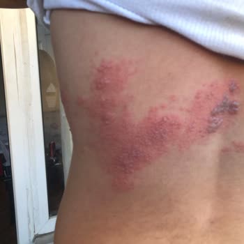 Yanlış Botoks Uygulaması Sonrası Görme Kaybı Ve Ciddi Mağduriyet Yaşadım