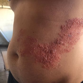 Yanlış Botoks Uygulaması Sonrası Görme Kaybı Ve Ciddi Mağduriyet Yaşadım