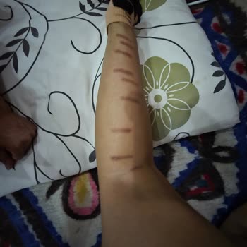 Yanlış Lazer Uygulaması Sonucu Ciltte Kalıcı Lekeler Ve İlgisizlik