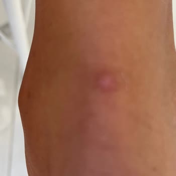 Adidasın Kalitesiz Ayakkabısı Oğlumun Ayaklarını Parçaladı Değişim Yapılmadı