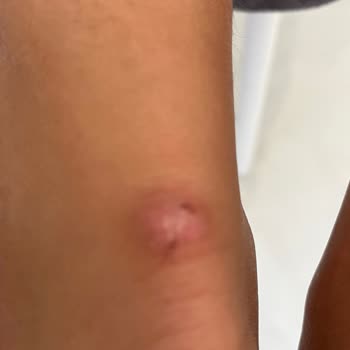 Adidasın Kalitesiz Ayakkabısı Oğlumun Ayaklarını Parçaladı Değişim Yapılmadı