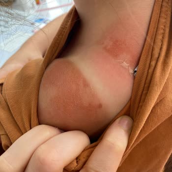 Sebamed Güneş Kremi Çocuklarımda Ciddi Yanıklara Sebep Oldu