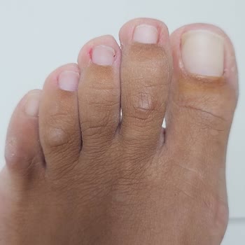 Pedikür Hizmetinde Hijyen Ve Özen Eksikliği