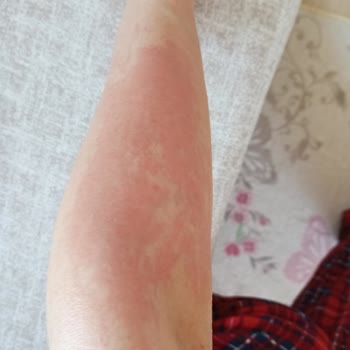 BİM'den Alınan Ağda Bandı Ciltte Yanık Ve İz Oluşturdu, Mağduriyetim Giderilmiyor