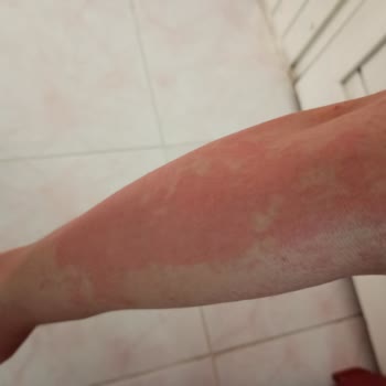 BİM'den Alınan Ağda Bandı Ciltte Yanık Ve İz Oluşturdu, Mağduriyetim Giderilmiyor