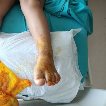 Termos Patlaması Sonucu Çocuğumda Yanık Ve Mağduriyet