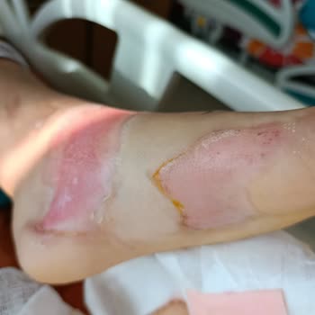 Termos Patladı Kızım Ağır Yaralandı Özdilek Dönüş Yapmıyor