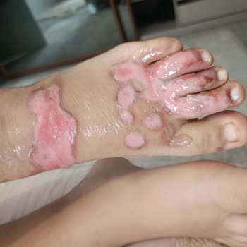 Termos Patladı Kızım Ağır Yaralandı Özdilek Dönüş Yapmıyor