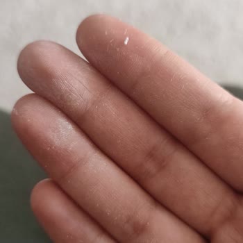 Bioderma Güneş Kremi Yüzümde Soyulma Ve Pul Pul Dökülme Yapıyor