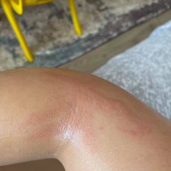 Egzamalı Çocuğumda Stelatopia Krem Ve Şampuan Sorunu