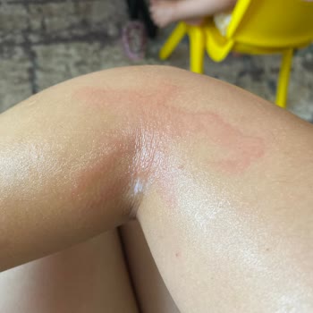 Egzamalı Çocuğumda Stelatopia Krem Ve Şampuan Sorunu