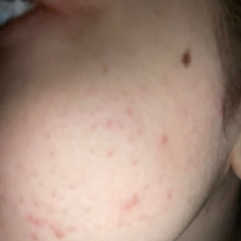 The Purest Solutions Toniği Sonrası Cildimde Beklenmeyen Sorunlar Oluştu