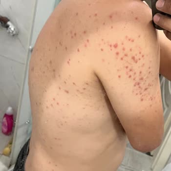 Tüy Dökücü Ürün Cildimde İz Bıraktı, Psikolojim Bozuldu