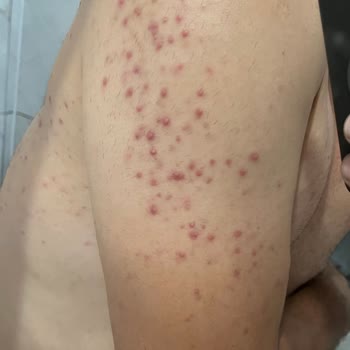 Tüy Dökücü Ürün Cildimde İz Bıraktı, Psikolojim Bozuldu