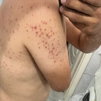 Tüy Dökücü Ürün Cildimde İz Bıraktı, Psikolojim Bozuldu