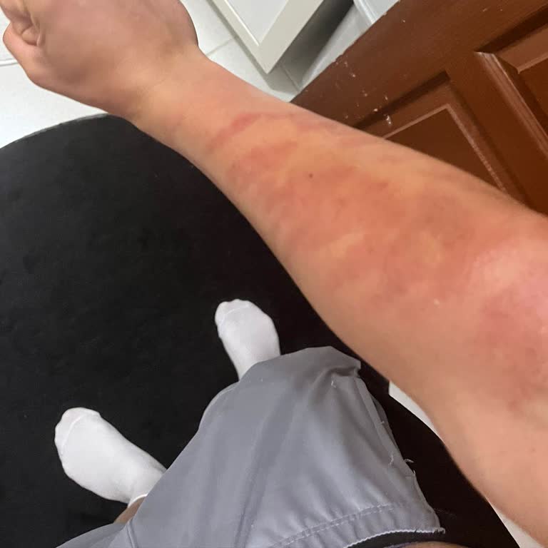 Lazer Epilasyon Sonrası Çocuğumda Yanık Oluştu, Merkezde Uzmanlık Ve Sorumluluk Eksikliği