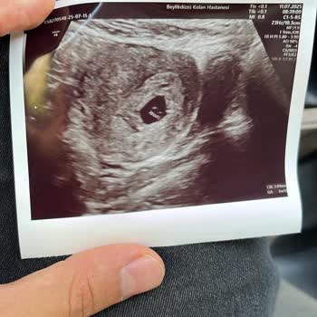 Zorunlu Kürtaj İşleminin Cerrahi Teminat Kapsamında Karşılanmaması Mağduriyetim