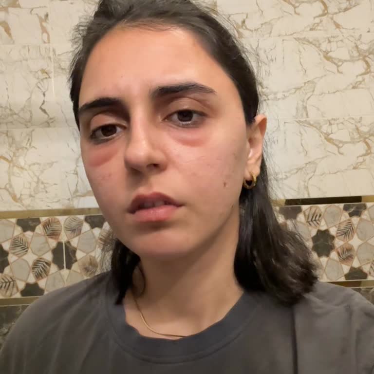 Beauty Formulas Göz Altı Jeli Ciltte Ciddi Reaksiyona Sebep Oldu