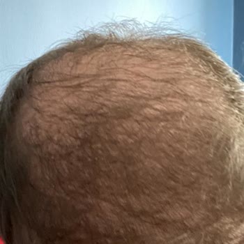 Clinic Expert'te Saç Ekimi Sonrası Hayal Kırıklığı: Sözler Tutulmadı, Sonuç Olumsuz