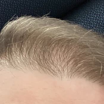 Clinic Expert'te Saç Ekimi Sonrası Hayal Kırıklığı: Sözler Tutulmadı, Sonuç Olumsuz