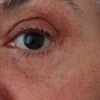 Ameliyat Sonrası Gözaltı Estetiğinde Mağduriyet Ve Revizyon Sorunu