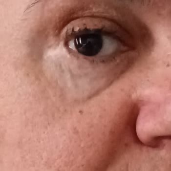 Ameliyat Sonrası Gözaltı Estetiğinde Mağduriyet Ve Revizyon Sorunu